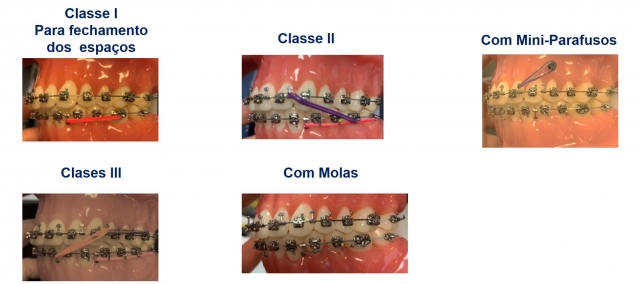 gancho anatomico casos gancho anatomico casos